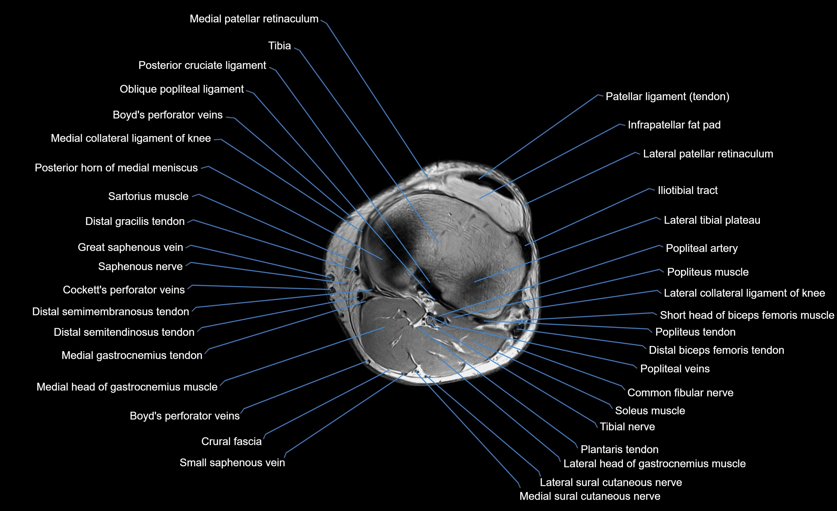 MRI lower leg axial cross sectional anatomy 3T  radiology  image-img-00001-00018.webp